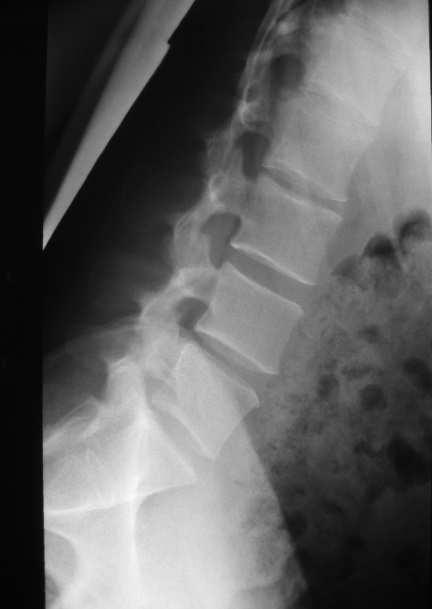 CRITERI DI CORRETTEZZA= rappresentazione delle vertebre da D12 al sacro in massima estensione e flessione; peduncoli