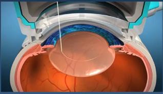 Il laser a femtosecondi utilizza una luce infrarossa con impulsi della grandezza di pochi micron e di brevissima durata che può essere focalizzata a diverse profondità nell occhio per tagliare i