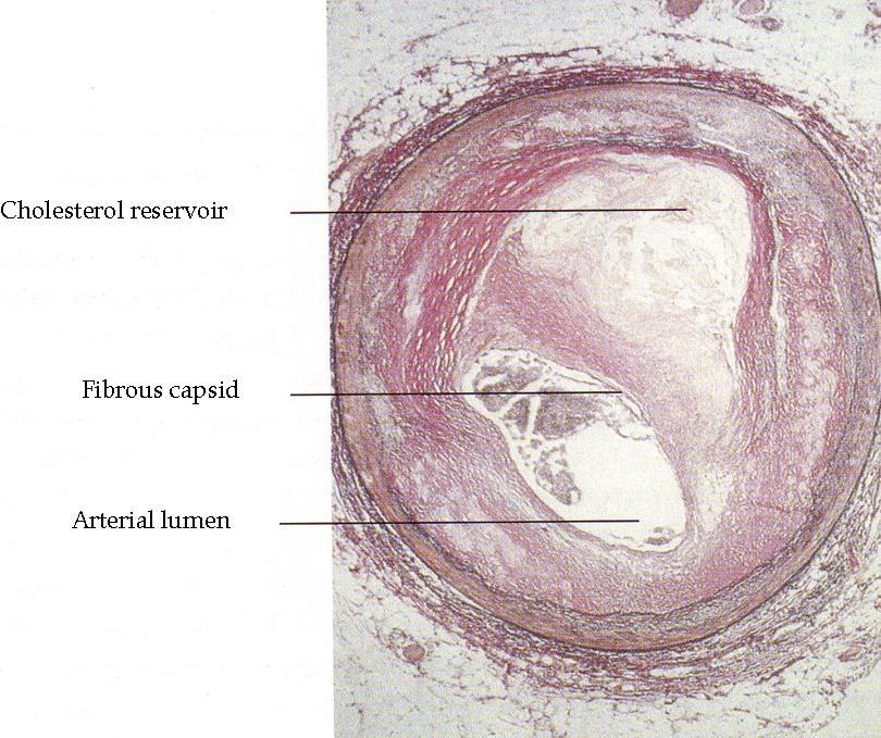 Aterosclerosi: Malattia degenerativa