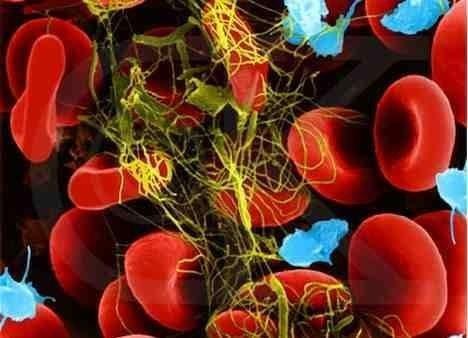 Se il grado di anemia è severo, è indicata la trasfusione di Eritrociti Concentrati.