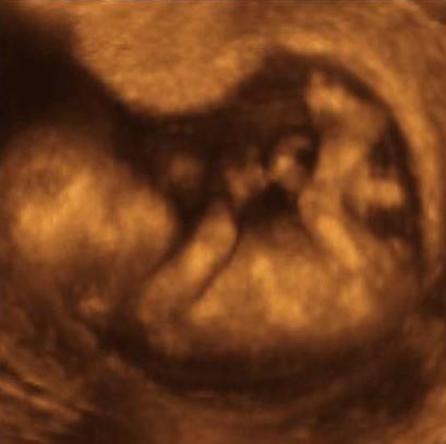 CELLULE STAMINALI FETALI Sono estratte dal feto dalla decima settimana fino alla nascita.