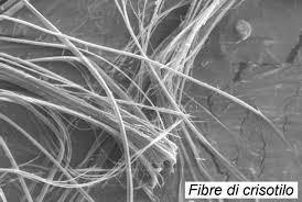 Mesotelioma È un tumore delle cellule del mesotelio, cioè il tessuto che costituisce pleura e peritoneo.