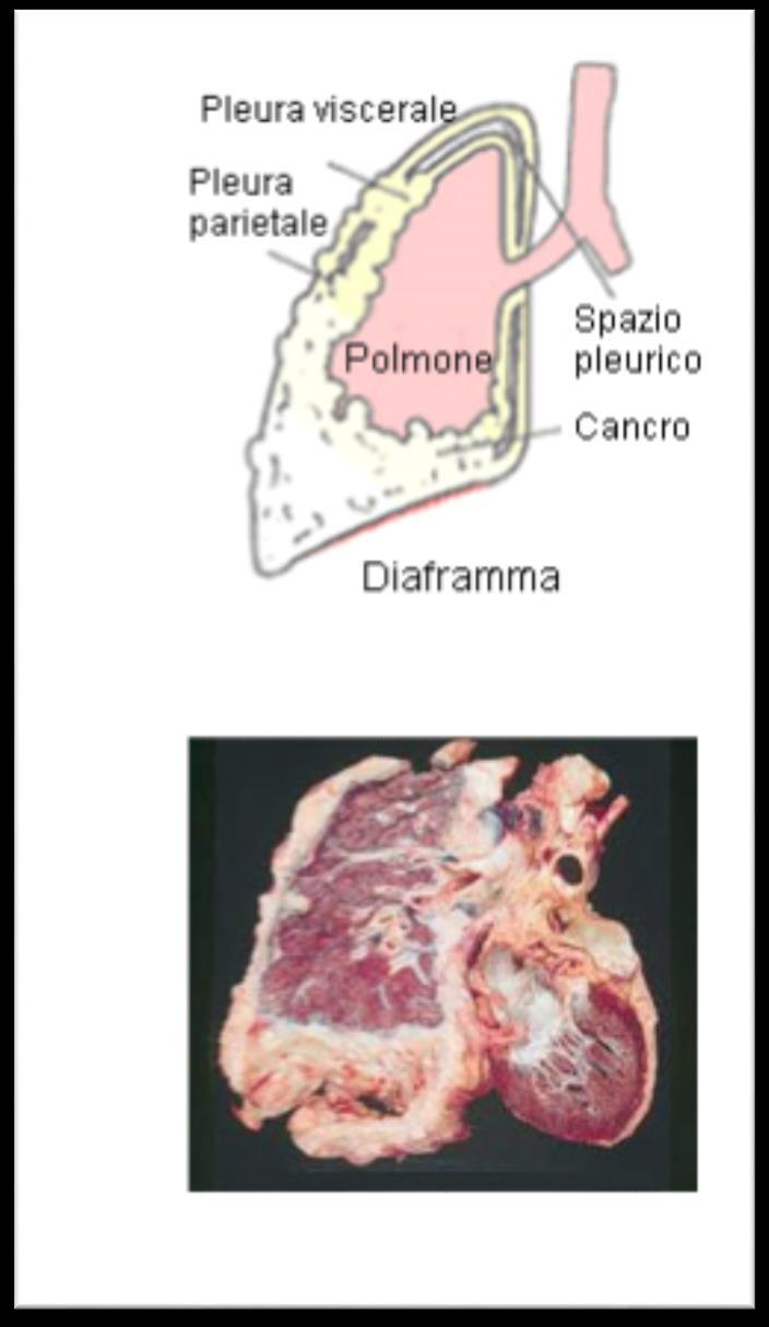 Si ritiene che il mesotelioma si sviluppi a partire dalla pleura parietale.