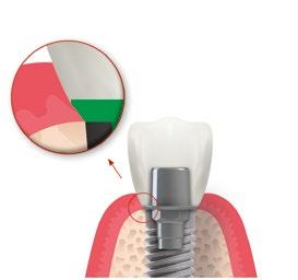 Il profilo di emergenza riveste un ruolo determinante nella realizzazione di corone dall aspetto sano e naturale montate su impianti.