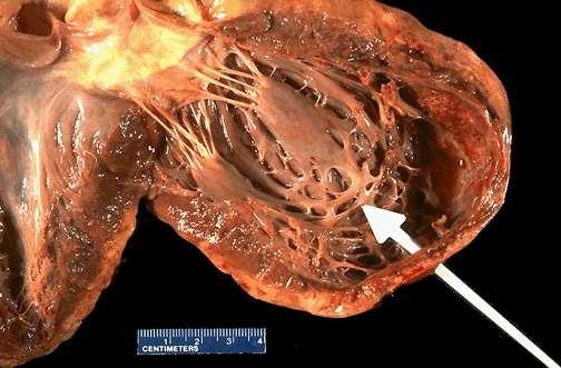 Le valvole atrioventricolari sono sottili lembi di connettivo fibroso