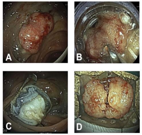 Endoscopic full-thickness resection «EFTR» 110 pazienti (20-90 anni) Residui o ricorrenze Non-lifting Lesioni sospette per adenoca T1 Lesioni