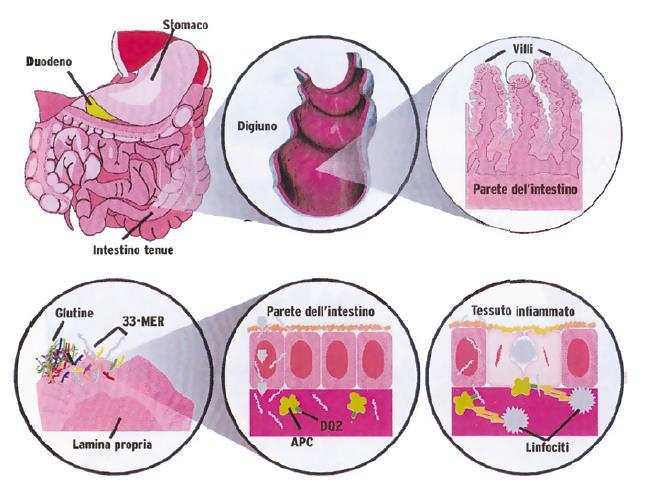 Allergie e intolleranze alimentari La celiachia causa infiammazione dei villi intestinali e