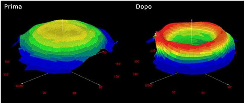 L azione è sullo strato più esterno della cornea che è l epitelio che viene modificato.