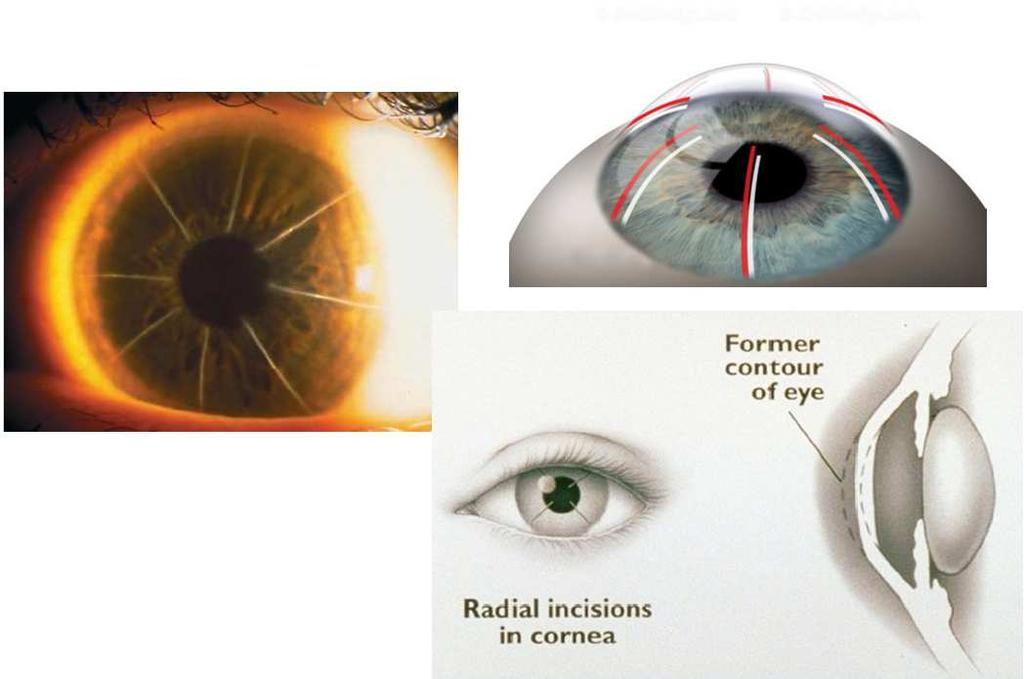 Chirurgia refrattiva E possibile cambiare il potere diottrico dell occhio operando su 2 porzioni di esso: CRISTALLINO CORNEA Attualmente il cristallino viene estratto mediante tecnica ad ultrasuoni o