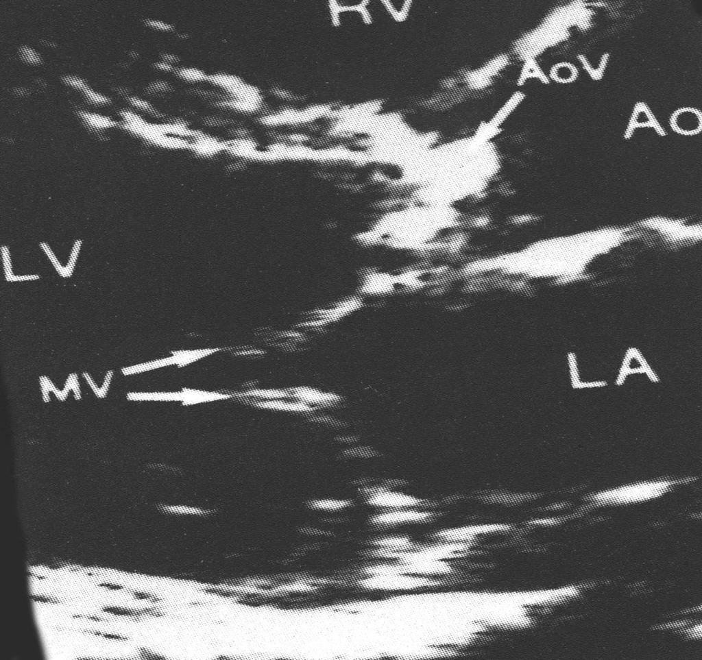 La stenosi valvolare aortica Diagnosi strumentale Ecocardiografia L ecocardiografia transtoracica bidimensionale riconosce