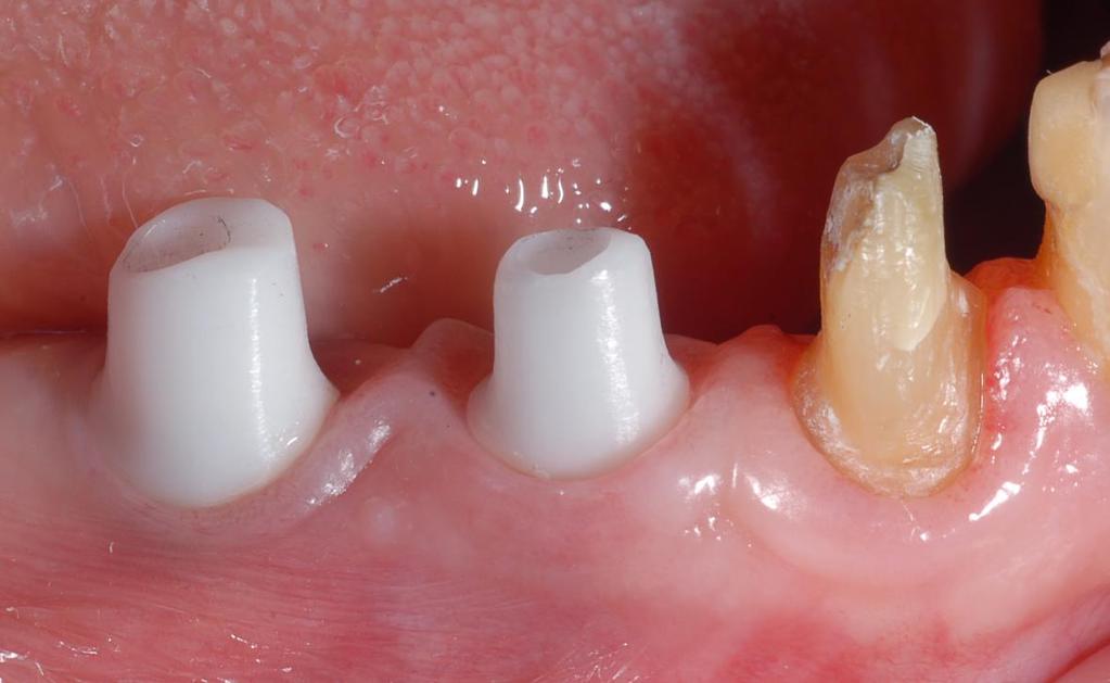 MATERIALE IPOALLERGENICO: Gli impianti in zirconia non danno allergie.