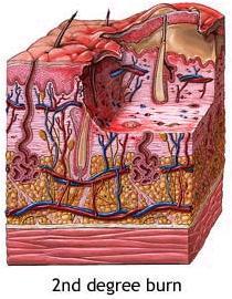 VI SCENARIO: USTIONE SECONDO GRADO Vesciche Bollose Danno a epidermide e