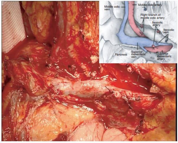 Mesocolon