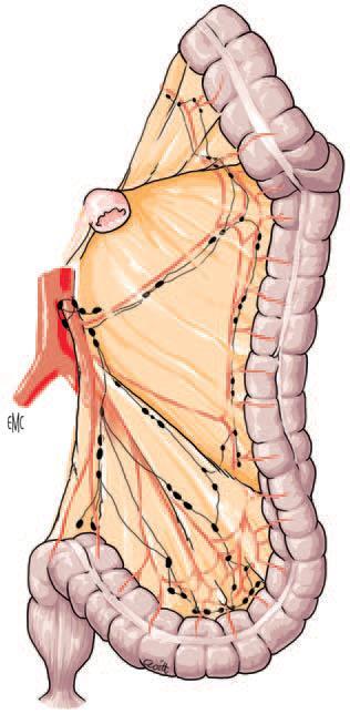 Emicolectomia sinistra