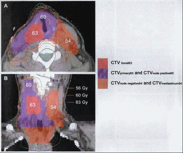 TECNICA IMRT Transverse (A) and coronal (B) sections of a patient with papillary carcinoma who was treated with IMRT following resection of a second recurrence involving the right side of the