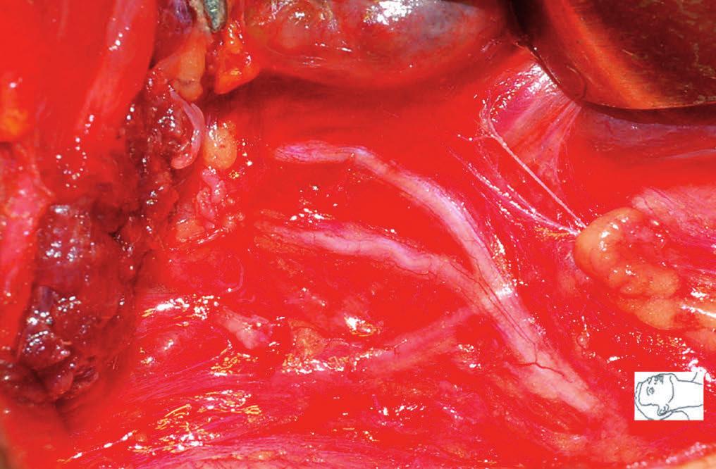 Capitolo 1 LA LARINGE 21 Figura 1.12. Immagine intraoperatoria del nervo laringeo ricorrente.