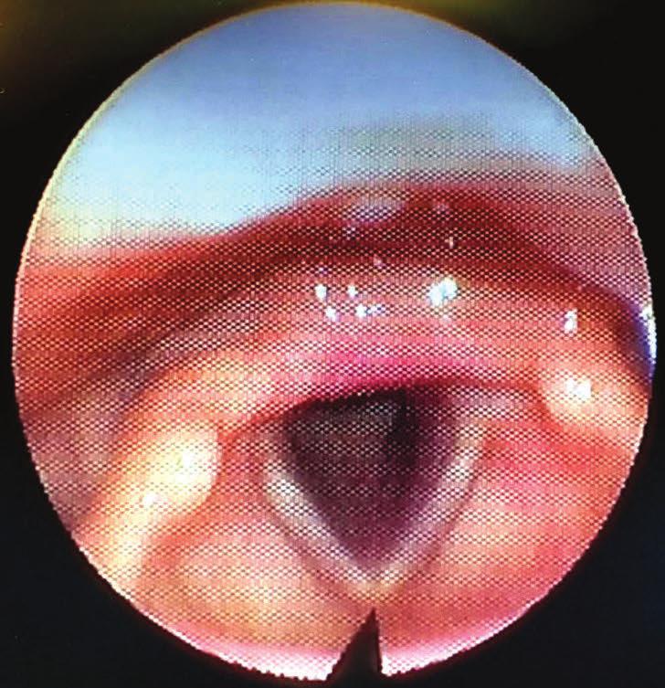 La modificazione più importante si ha durante la deglutizione, quando la ventilazione è interrotta da potenti riflessi che tendono a ridurre il gradiente pressorio fra la trachea e l istmo delle