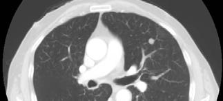 Esami radiologici TC torace e addome cmdc Torace : riscontro di nodulo polmonare al
