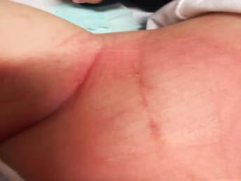 sutura continua intradermica con filo riassorbibile - Dare
