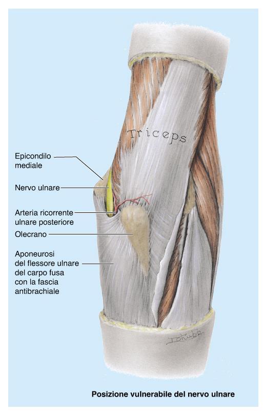Lesioni del nervo ulnare: distale (canale del Guyon) prossimale