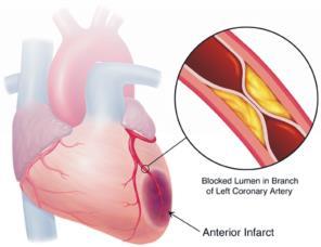 L aumento della pressione è detto ipertensione e può essere dovuto ad alterazioni delle pareti delle arterie che perdono la loro elasticità (arteriosclerosi e aterosclerosi).