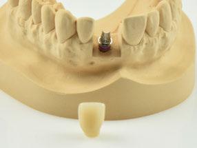 realizzare una progettazione anatomica ridotta o una corona a contorno pieno in base alle indicazioni del materiale dentale utilizzato.