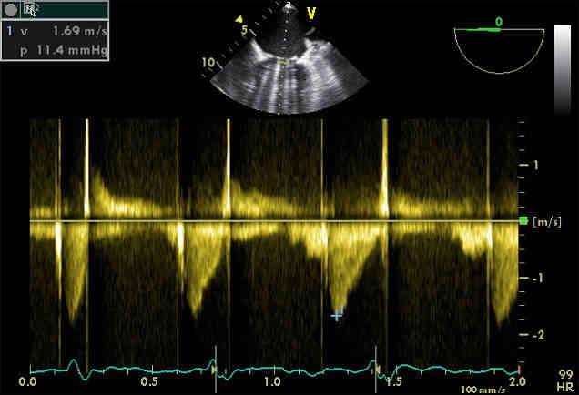 Condizioni di Normalità Homograft: velocità di picco simili alla valvola nativa Bioprotesi