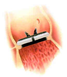 PROTESI AORTICHE Produrre minime cadute di pressione Accorgimenti di tecnica chirurgica Nel caso di anulus aortico piccolo si può ricorrere all impianto di protesi sopra anulari con