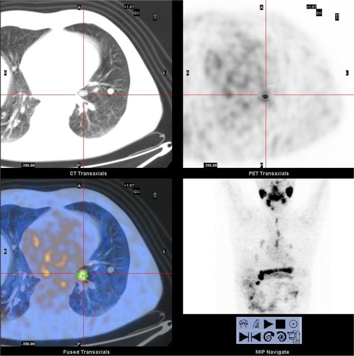 Segmentazione delle immagini CT ROI su immagini 124I PET sequenziali: Bq/ml RC correction.