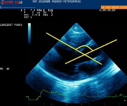 Dallo stesso clip è stato misurato anche l angolo aorto-settale (Figura n.