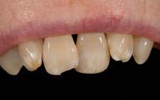 Per riprodurre le naturali caratteristiche individuali dei denti dei vostri pazienti potete scegliere Venus Color fra cinque diversi colori: Choco Amber Corn Blue White I vostri pazienti si