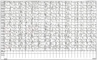 seguiti da lamenti ed espressioni di dolore..eeg standard! Tracciato EEgrafico compatibile con possibile encefalopatia epilettica.