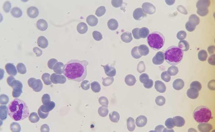 chronic lymphocytic leukemia and comparison with other karyotypic