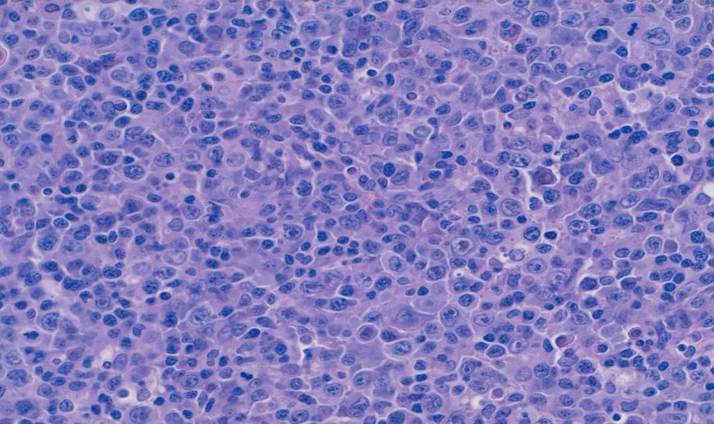 Linfoma B diffuso a grandi cellule Classificazione WHO 2017: Varianti morfologiche: centroblastico,