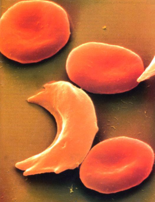 Emoglobinopatie: anemia falciforme, è dovuta a