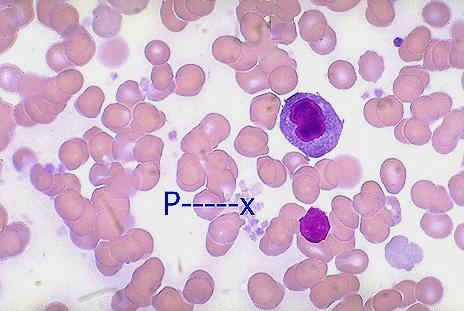 PIASTRINE o trombociti (thrombos=grumo) Non sono delle vere cellule, in quanto non hanno nucleo; sono frammenti