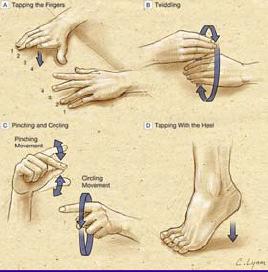 Parkinson s disease: Gait disorders JAMA 2003; 289(3):347 31 Parkinson s disease Usually Other Accompanied Autonomic