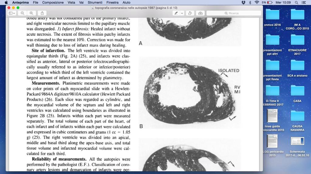 Infarto isolato del ventricolo destro 2-3% di tutti gli infarti del miocardio Quadri coronarografici più frequenti: 1.