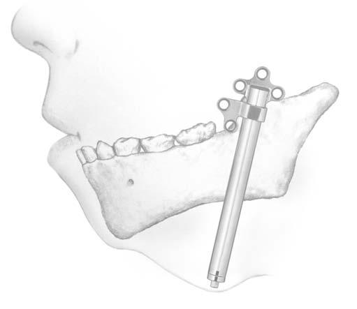 Tecnica chirurgica Tecnica chirurgica per il distrattore mandibolare 1. Determinare la posizione del distrattore Esporre il campo chirurgico con un approccio intraorale.