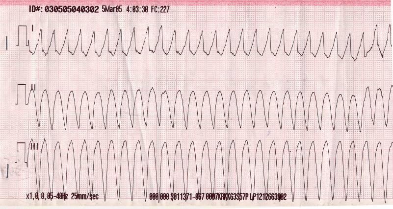 Tachicardia Ventricolare La TV è definita come una serie di 3 o più battiti ventricolari consecutivi ad una frequenza compresa tra 140-250 batt/min.