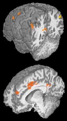 Aree del craving visibili Oggi il craving può essere visualizzato mediante una mappatura topografica delle aree