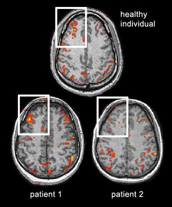 Disturbi nella corteccia prefrontale (PFC) nella schizofrenia e nei disordini affettivi Molte evidenze suggeriscono che ci sono importanti disturbi nella corteccia prefrontale anche nella