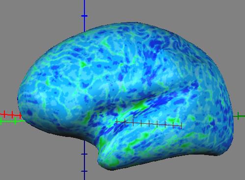 Spessore corticale Misura dello spessore corticale, espressa in millimetri.