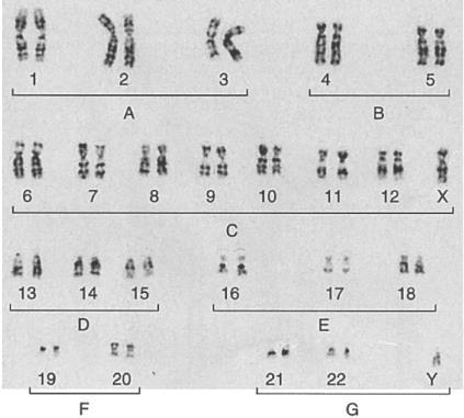 Cromosomi Cariotipo umano: