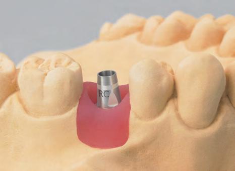 Procedura protesica Variante A: Presa d impronta a livello della componente secondaria Procedura protesica 1a Passo 1 Inserimento della componente secondaria ppselezionare la componente secondaria