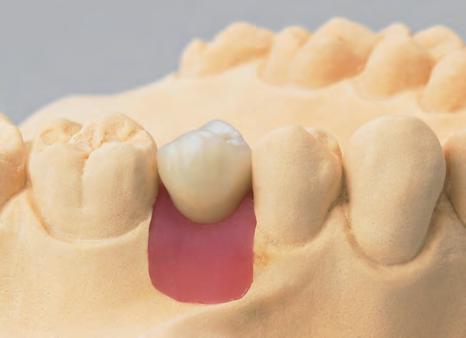 Procedura protesica Procedura protesica La ricostruzione definitiva è consegnata allo studio odontoiatrico sul modello master.
