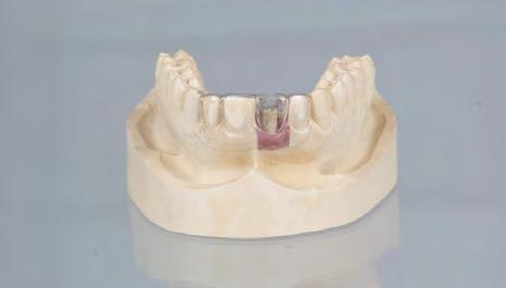 In caso di utilizzo di cappette in titanio Sulla base dell impronta dentale, preparare il modello master utilizzando l analogo adeguato.