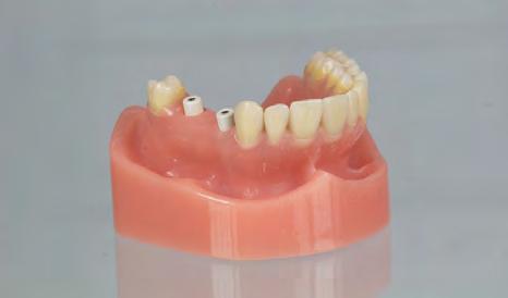 Procedura di laboratorio Restauro di più denti (dente #4-6] Restauro provvisorio In caso di utilizzo di cappucci protettivi Montare i cappucci protettivi sulla componente secondaria e serrare a mano
