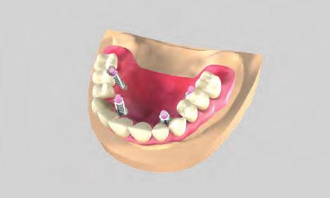 Nella bocca del paziente, collegare le cappette in titanio alla protesi