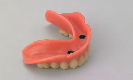 Procedura protesica Ricostruzione definitiva L odontotecnico riconsegna la protesi overdenture LOCATOR al dentista per l inserimento definitivo.